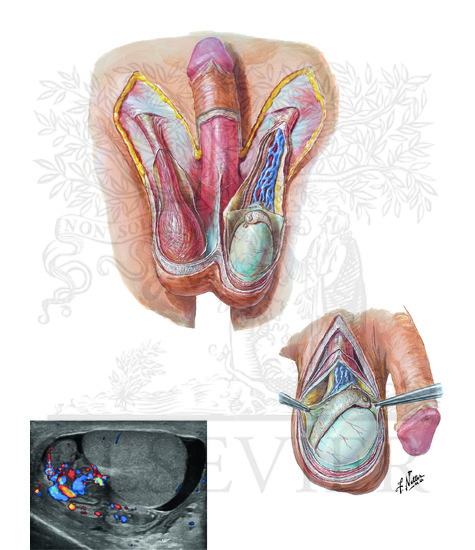Watermarked preview of unlabeled image: Scrotum and Contents
