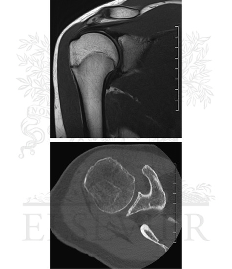 Shoulder MRI and CT Scan