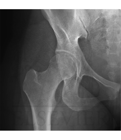 Hip Joint: Anteroposterior Radiograph