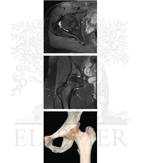 Hip Radiograph, Arthrogram, and MRI