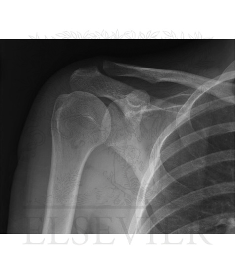 Shoulder: Anteroposterior Radiograph