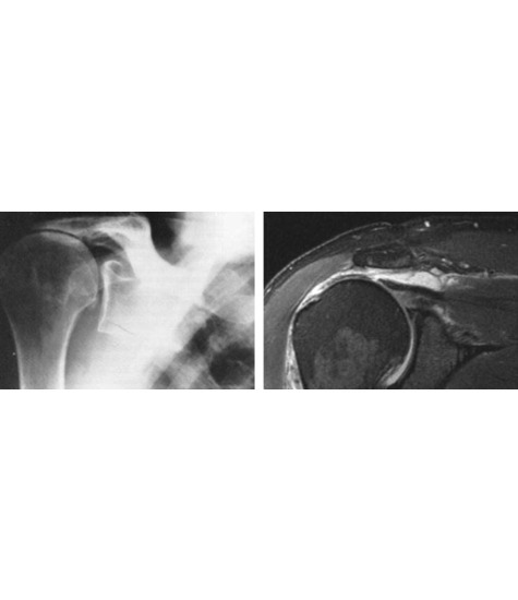 Imaging of Torn Rotator Cuff
