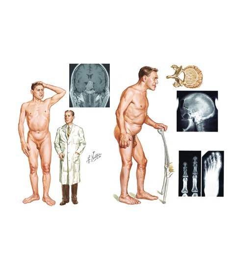 pituitary gigantism vs acromegaly