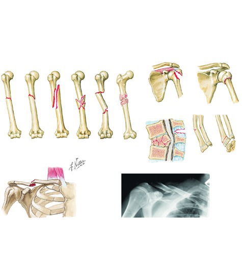 Watermarked preview of unlabeled image: Types of Fracture