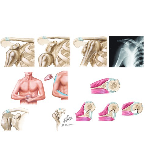 Dislocation of the Glenohumeral Joint