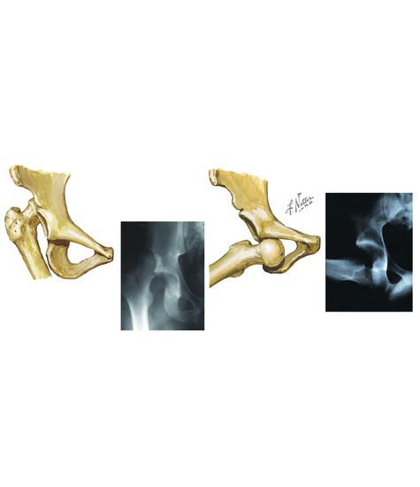 Dislocation of the Hip