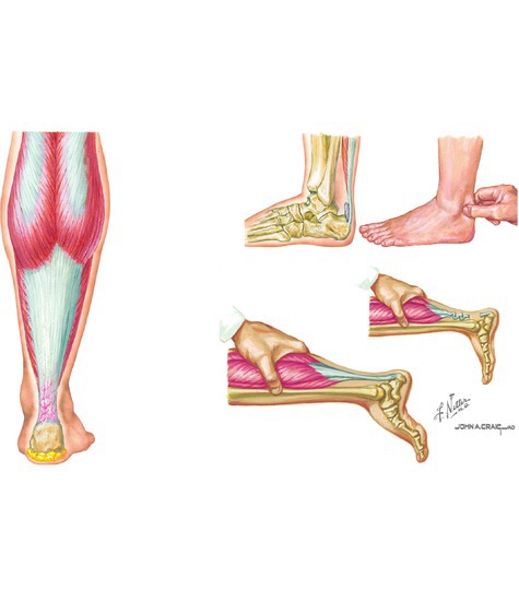 Calcaneal Tendon Rupture