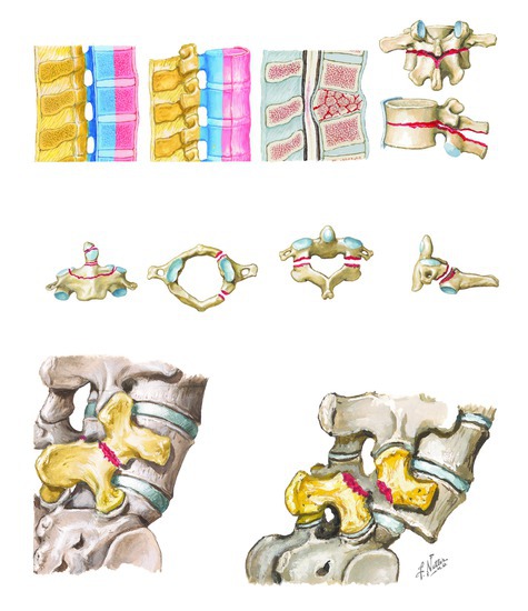 Stable and Unstable Spinal Injuries (Trauma, Cervical Vertebral Fractures, Spondylosis)