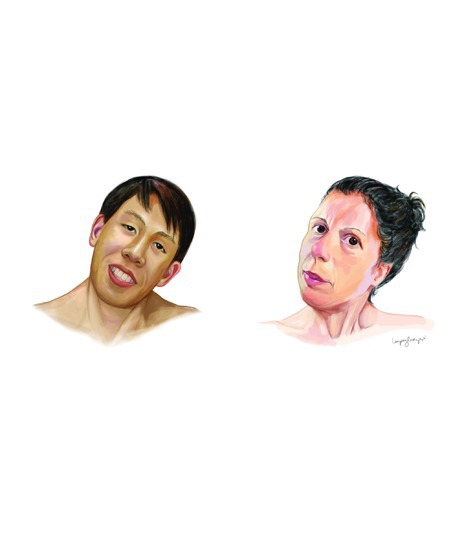 Cervical Dystonia