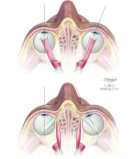 Extrinsic Eye Muscles (continued)