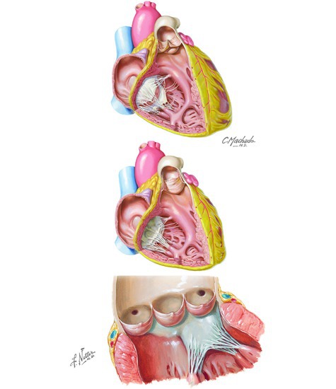 Heart valves