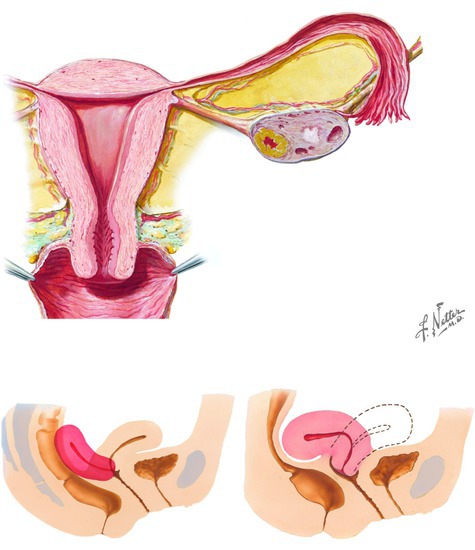 Illustration of Female Reproductive Organs: Uterus and Vagina  from the Netter Collection