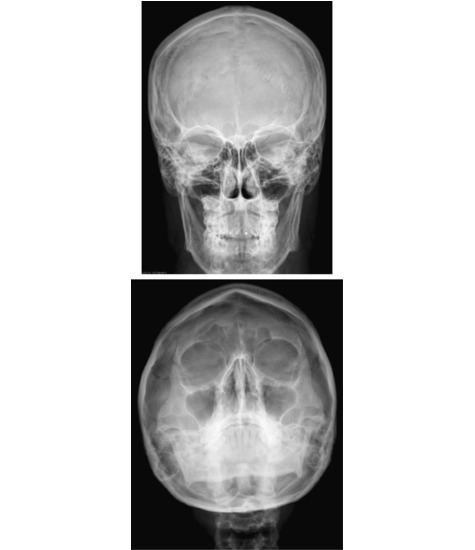 Skull: Radiographs