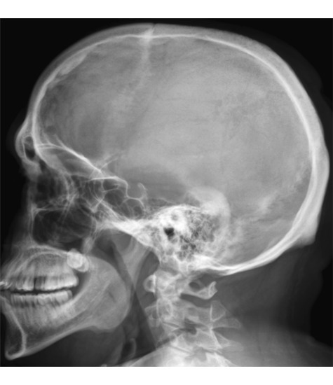Skull: Lateral Radiograph