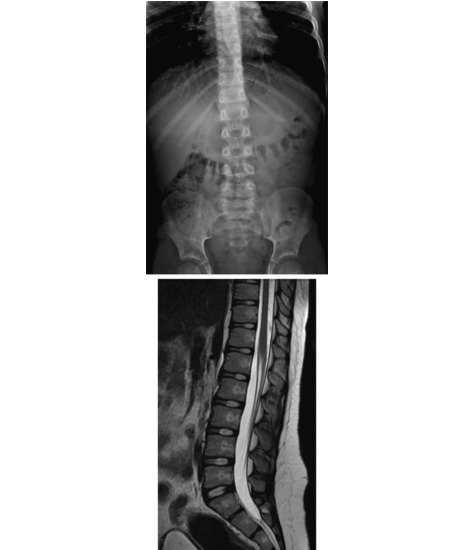 Watermarked preview of unlabeled image: Vertebrae: Radiograph and MRI