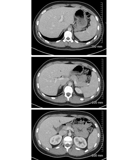 Abdominal Scans: Axial CT Images