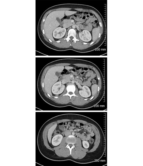 Abdominal Scans: Axial CT Images (continued)
