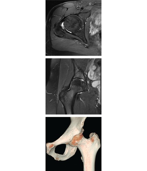 Hip MRI and 3D CT