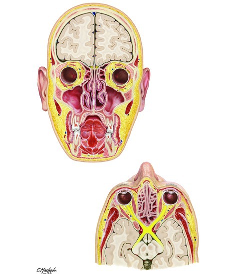 Paranasal Sinuses: Coronal and Transverse Sections