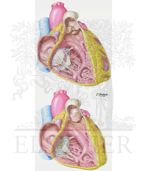 Heart Valves
