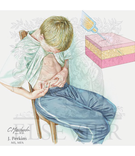 Subcutaneous injections 