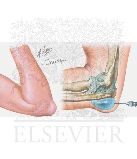 Bursitis