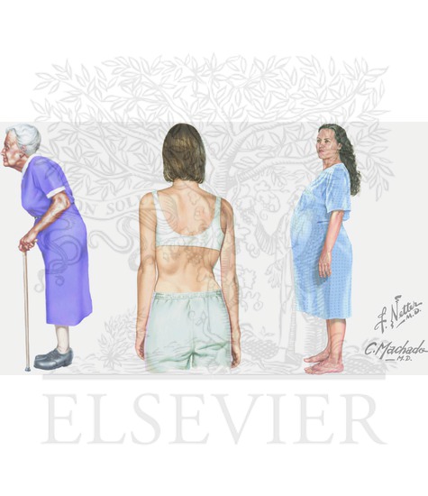 Kyphosis, Scoliosis, Lordoctic posture during pregnancy
