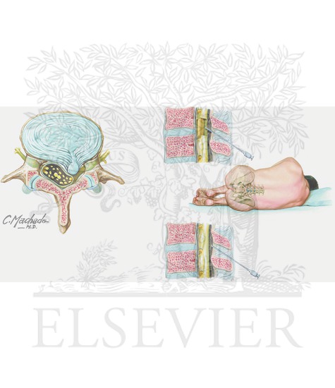 A herniated or ruptured disc 