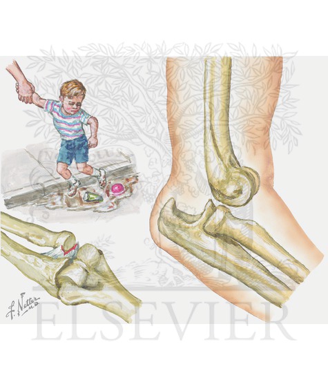 Watermarked preview of unlabeled image: Radial head subluxation (RHS) 