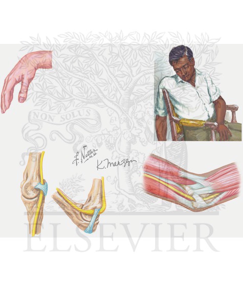 Radial nerve compression 