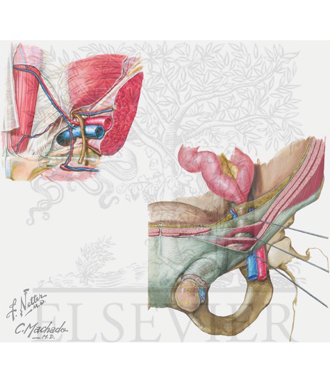 Inguinal hernia 