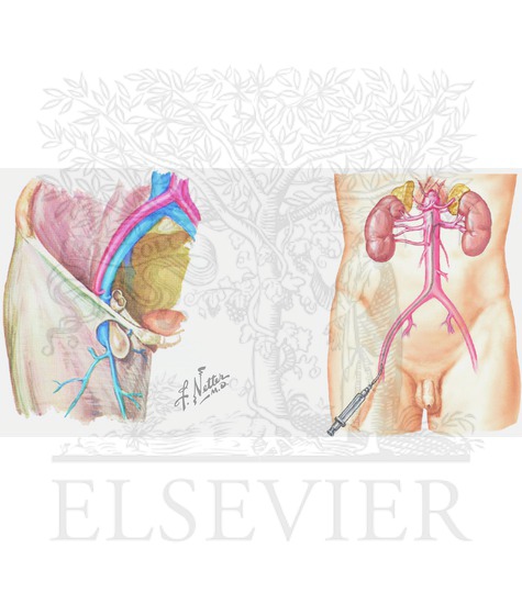 Femoral hernia