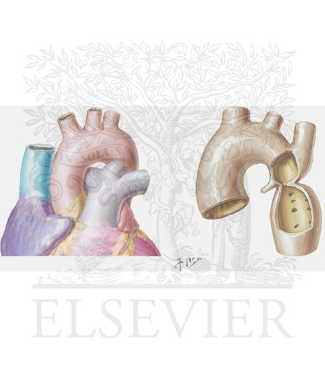 Patent Ductus Arteriosus