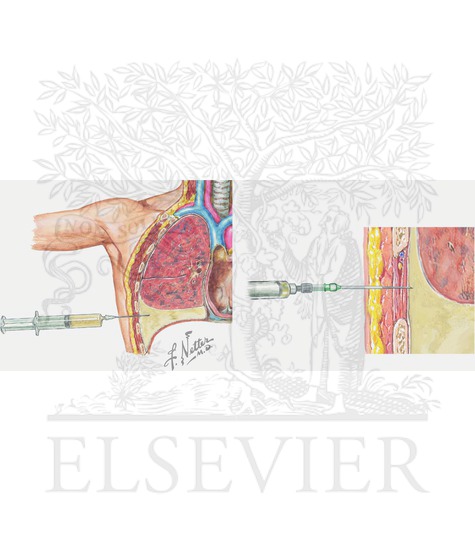 Sternal angle (thoracentesis to remove pleural effusion)