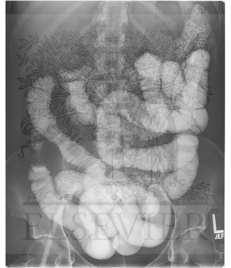 Imaging of Digestive Viscera: Fluroscopic small bowel examination