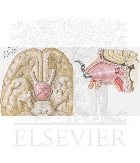 Pituitary tumors (pituitary adenomas) 