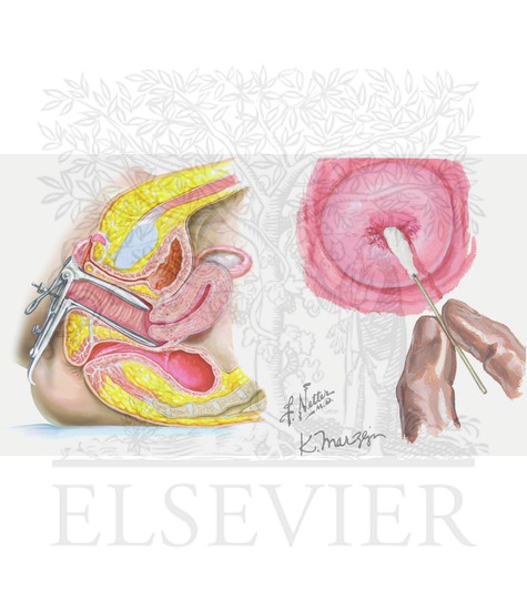 Illustration of Pelvic exam (pap smear) from the Netter Collection