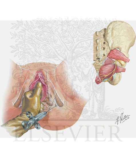 Pudendal nerve block (block anesthesia)