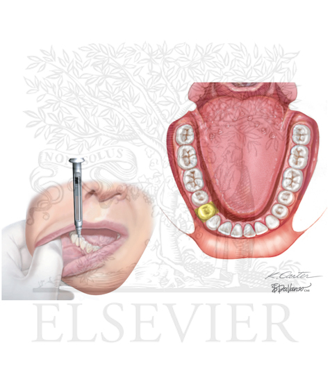 Watermarked preview of unlabeled image: Injections