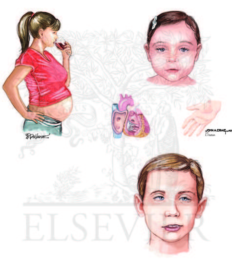 Watermarked preview of unlabeled image: Fetal Alcohol Syndrome  