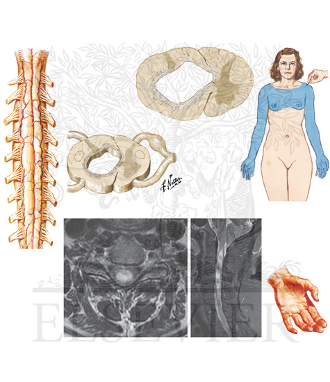 Syringomyelia