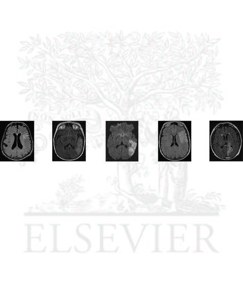 Aphasias: MRI Illustrations and Characteristic Language Dysfunction