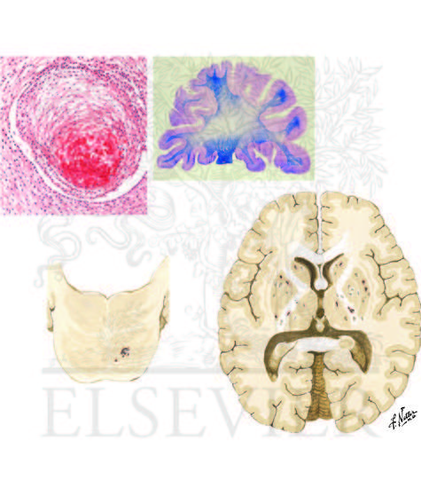 Watermarked preview of unlabeled image: Lacunar Infarcts 