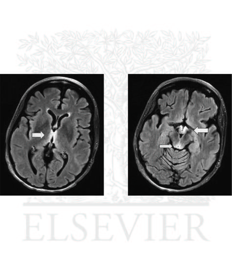 Wernicke Encephalopathy With MRI T2 Fluid-Attenuated Inversion Recovery (FLAIR) Changes Involving Medial Thalamus (1), Mammillary Bodies (2), and Periaqueductal Gray (3)