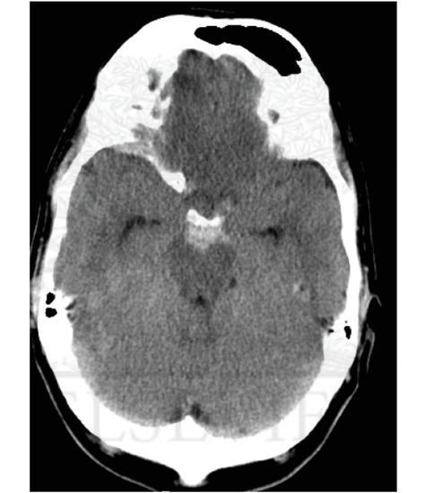 Perimesencephalic Subarachnoid Hemorrhage