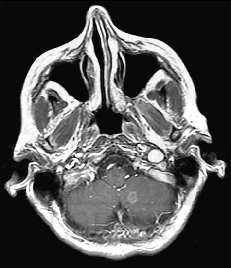 Watermarked preview of unlabeled image: Axial, Gadolinium Contrast‚ÄìEnhanced T1-Weighted Magnetic Resonance Image Shows 6-mm Enhancing Metastasis in Left Cerebellar Hemisphere