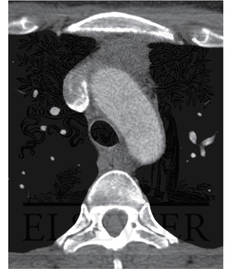 Watermarked preview of unlabeled image: Thymoma