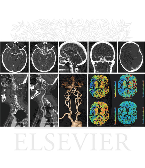 Computed Tomography Angiography (CTA), Computed Tomography Venography (CTV), and Computed Tomography Perfusion (CTP)