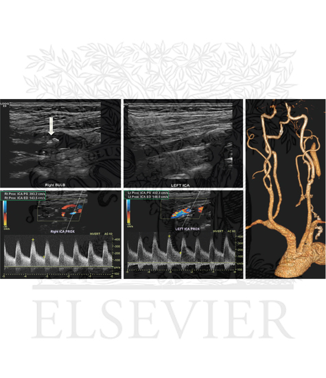 Vascular Ultrasound of the Carotid Bifurcations