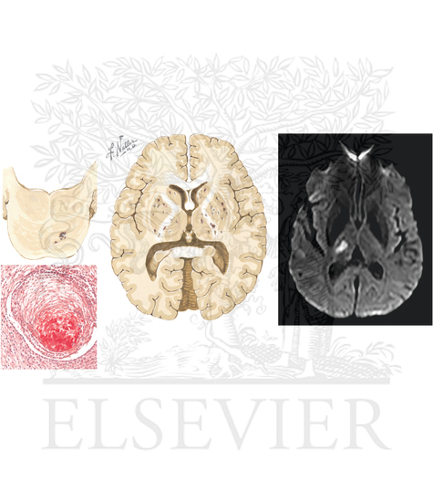 Watermarked preview of unlabeled image: Lacunar Infarction